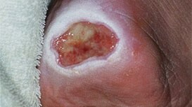 Periwound skin damage
