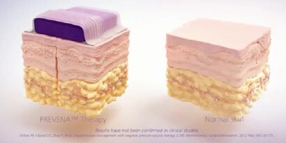 How Prevena Therapy works - video
