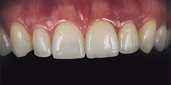 Treatment result with a veneer made of feldspathic ceramic and a handveneered crown with a coping made of 3M™ Lava™ Frame Zirconia.
