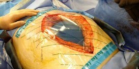 Open Abdomen Negative Pressure Therapy
