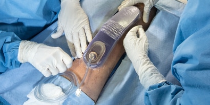 Prevena product application during surgery

