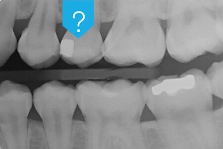 X-ray of teeth showing dental adhesive radiopacity
