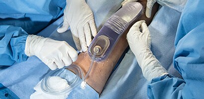 Surgeons in theatre using Prevena Therapy
