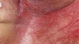 Intertriginous dermatitis
