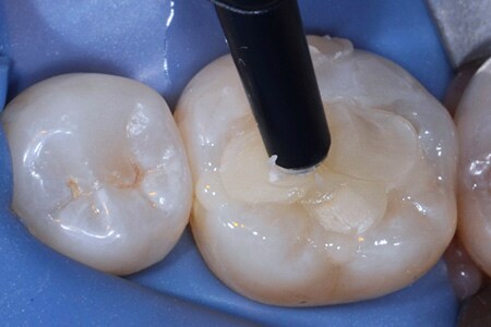 Placing Posterior Composite
