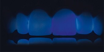 Translucency of the restorations and the adjacent teeth in transmitted blue light.
