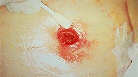 Peristomal skin damage
