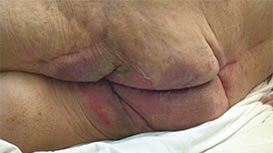 Incontinence-associated dermatitis
