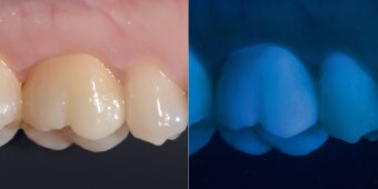 Lateral view of the monolithic crown on the first molar (left).  Photograph taken under UV light: The zirconia material shows a tooth like fluorescence (right).*
