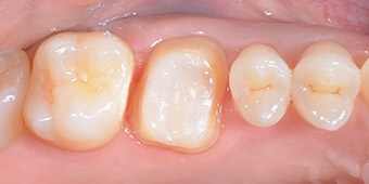 Crown preparation in the posterior region.
