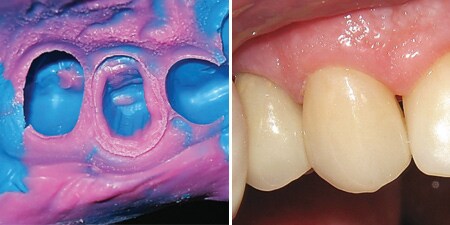 Clinical Case: Full porcelain crown
