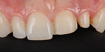 Veneer preparation on the left central incisor and crown preparation on the left lateral incisor.
