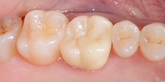 Monolithic crown made of 3M™ Lava™ Esthetic Fluorescent Full-Contour Zirconia in place.
