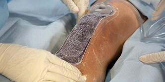 Prevena Peel and Place on a knee
